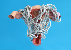 миома-матки