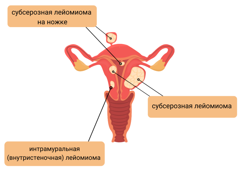 миома-матки