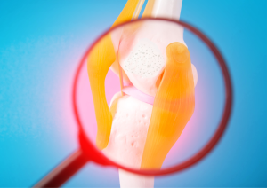 лечение-гонартроза