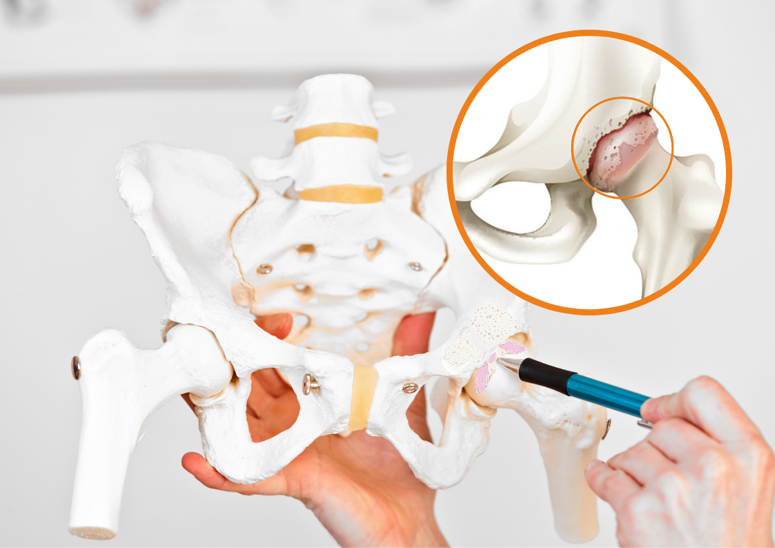 коксартроз-тазобедренного